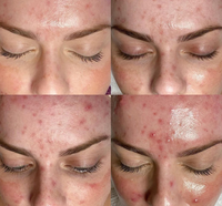 Acne - 4 stappen behandeling