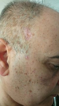 Verbeteren huid beschadiging _1